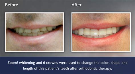 What Whitens Tooth Crowns? Brighter Smile Solutions What Whitens Tooth Crowns? Brighter Smile Solutions