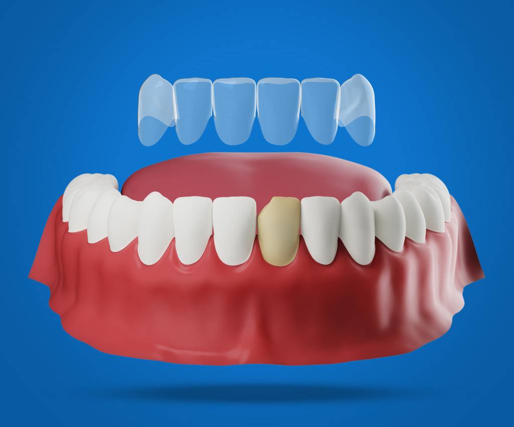 What Whitens Veneers Best? Expert Solutions