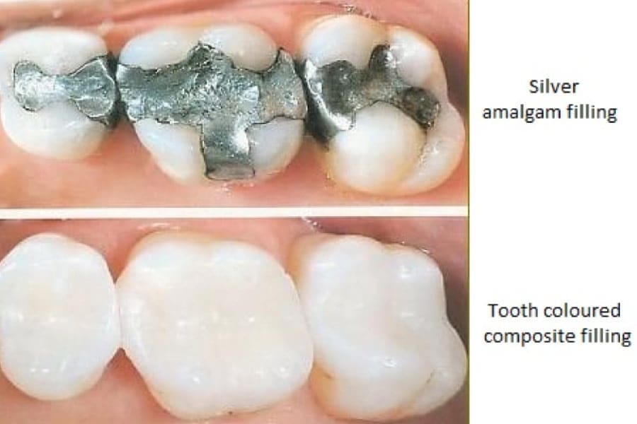 When Do Fillings Stop Hurting? Fast Solutions
