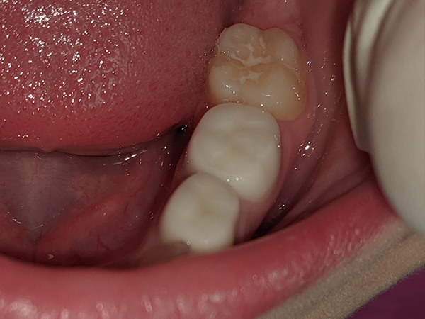 When Do I Need Crowns? Find Top Dentists When Do I Need Crowns? Find Top Dentists