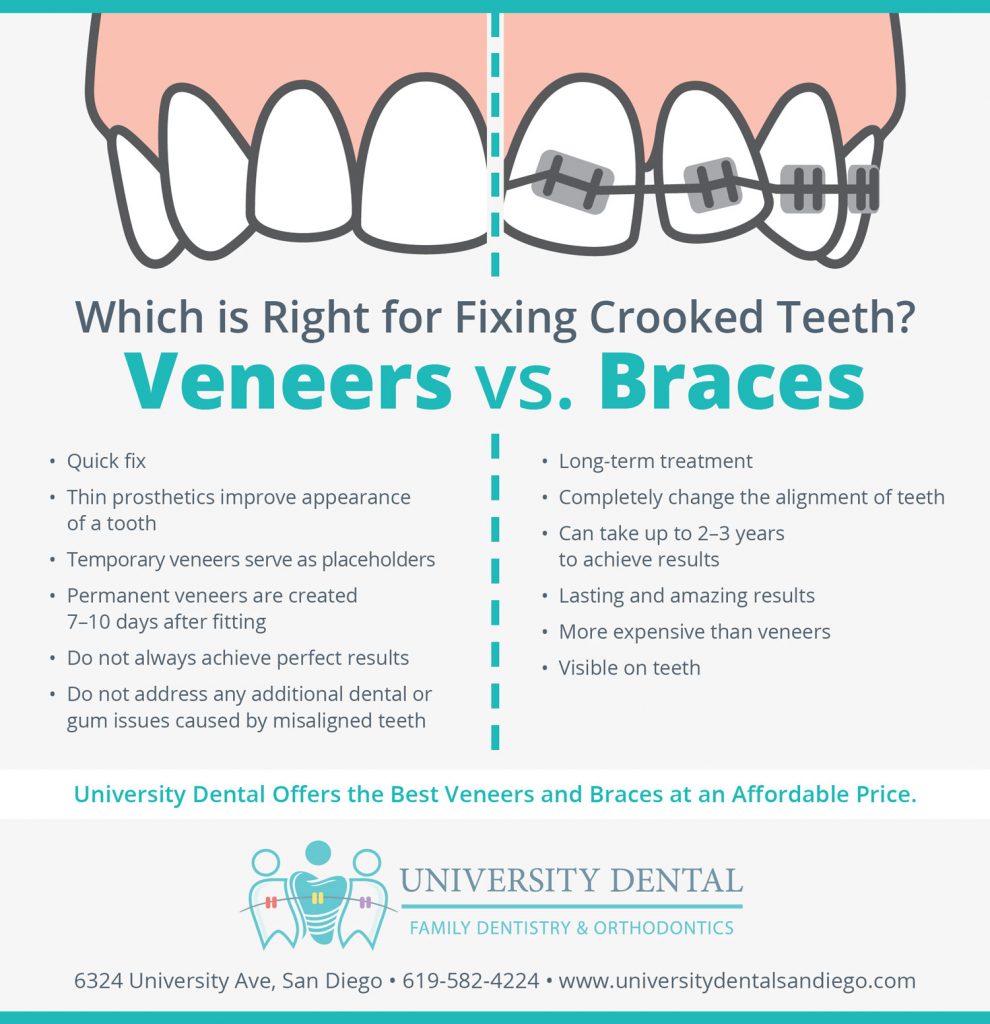 When Do I Need Veneers? Fixing Teeth Made Easy When Do I Need Veneers? Fixing Teeth Made Easy