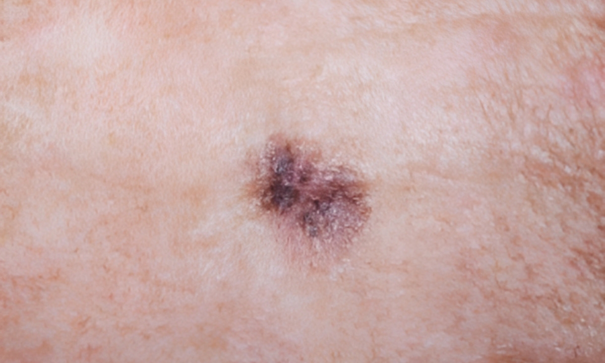When Do Temporal Bone Cancer Symptoms Appear? Early Detection Guide