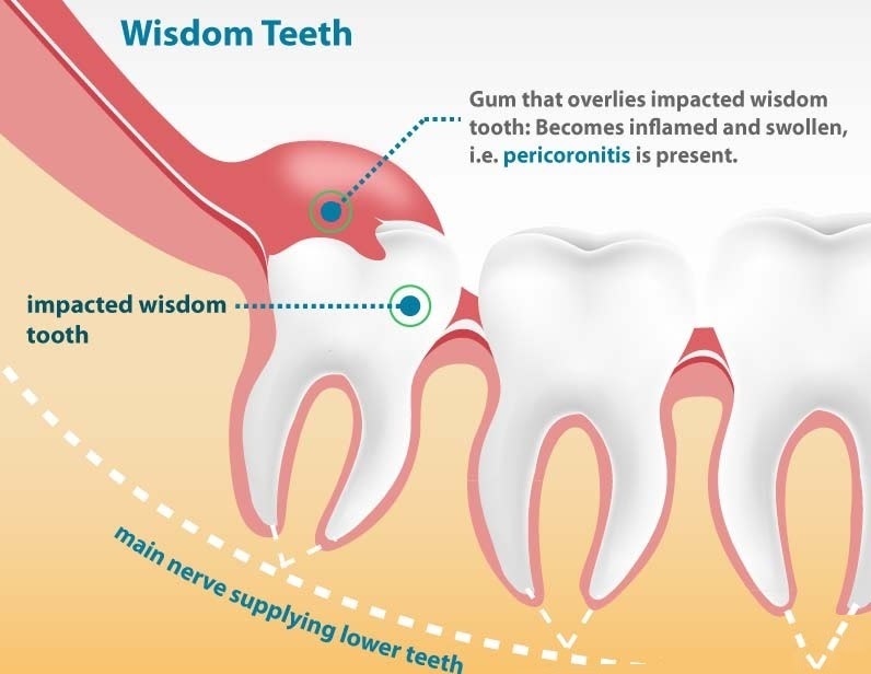 When Do Wisdom Teeth Need Filling? Expert Advice