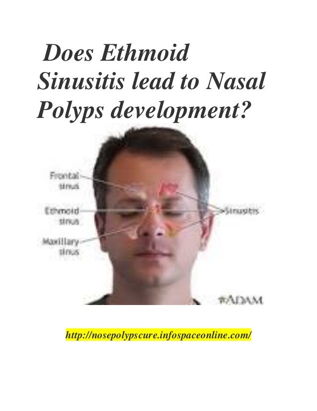 When Does Sinusitis Lead To Ear Pain? Solutions