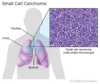 When Does Small Cell Lung Cancer Rash Appear? Early Signs