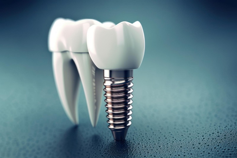 When To Choose Implant Over Bridge? Expert Advice Inside When To Choose Implant Over Bridge? Expert Advice Inside