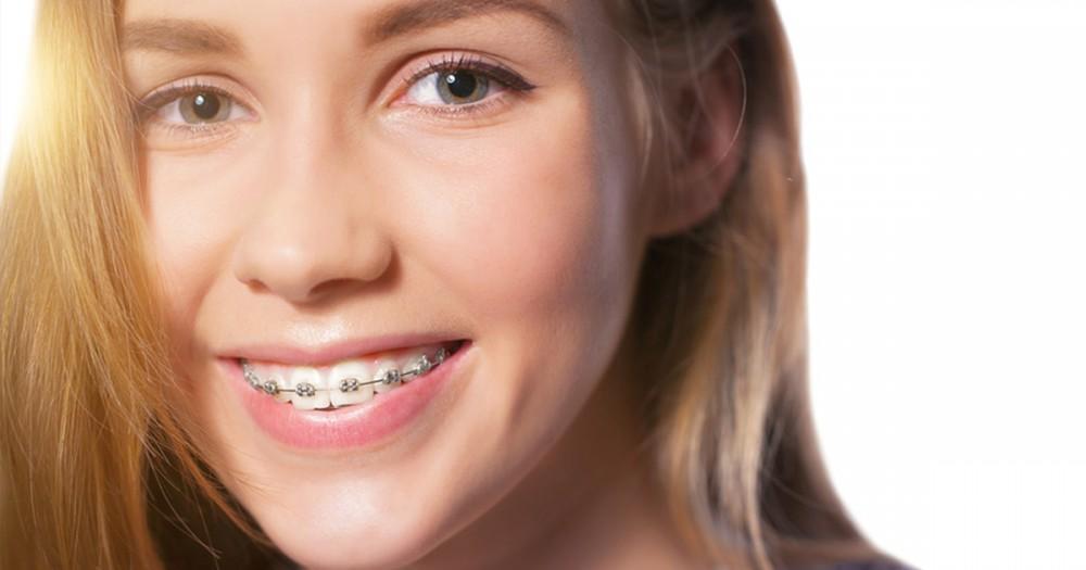 When To Get Braces? Find Your Perfect Smile Time
