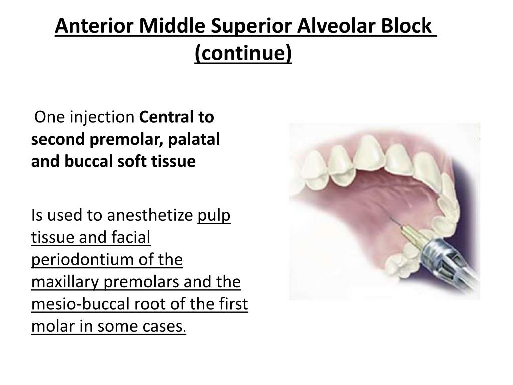 When To Use Anterior Superior Alveolar Block? Easy Anesthesia