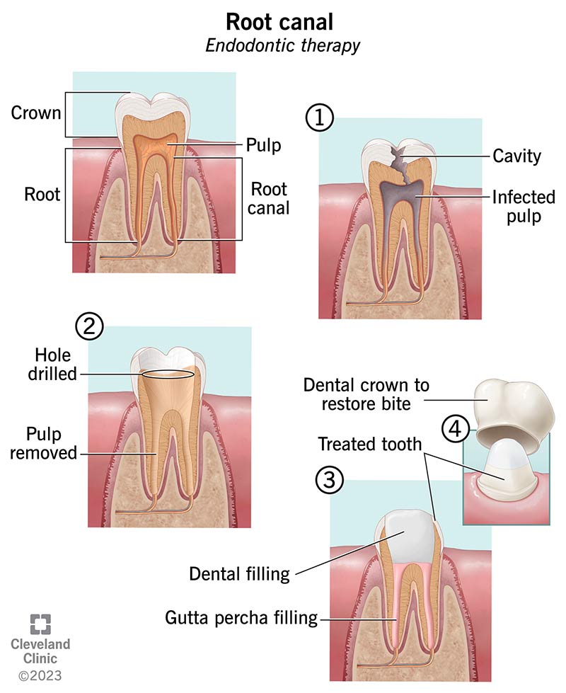 When Will Root Canal Sensitivity Stop? Healing Guide