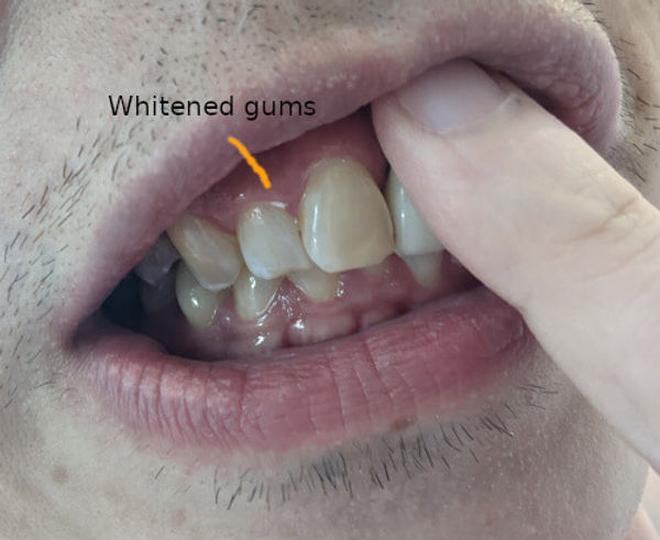 White Gums After Teeth Whitening