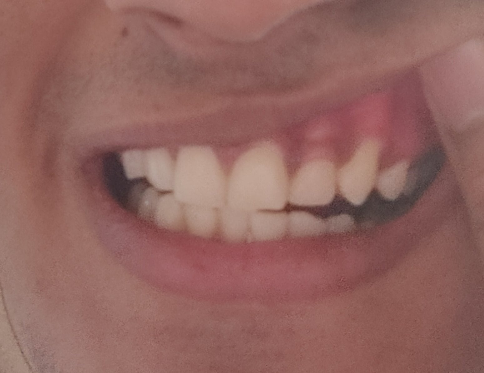 White Line Inside Cheek White Line Inside Cheek