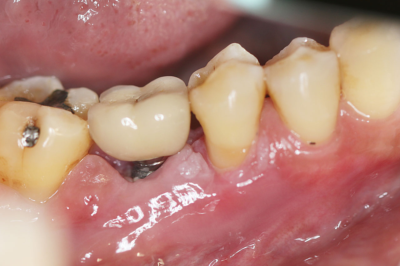 White Lining Around Teeth