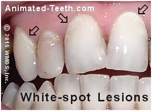 White Spots Between Teeth White Spots Between Teeth