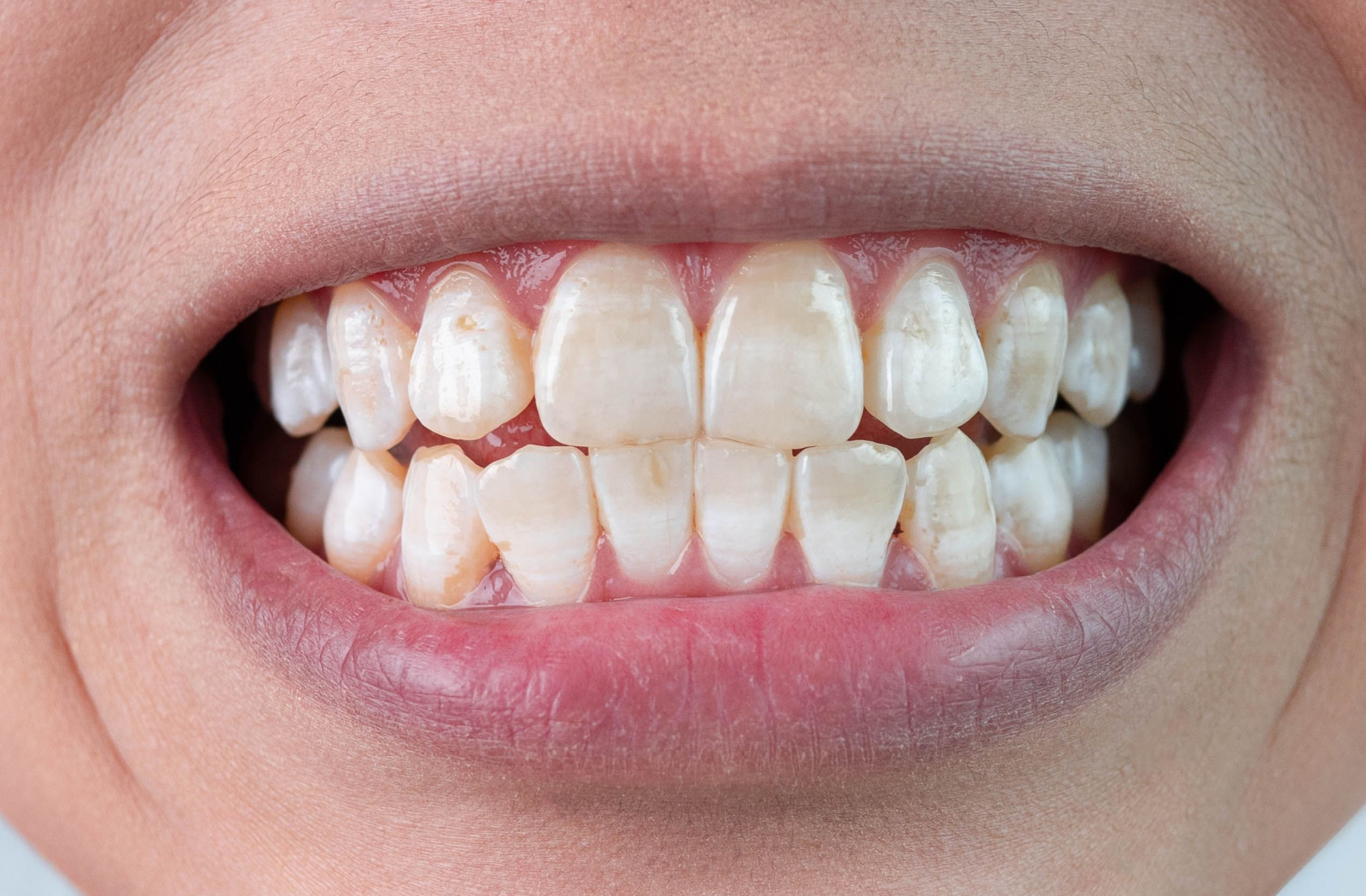 White Spots On Teeth Calcium
