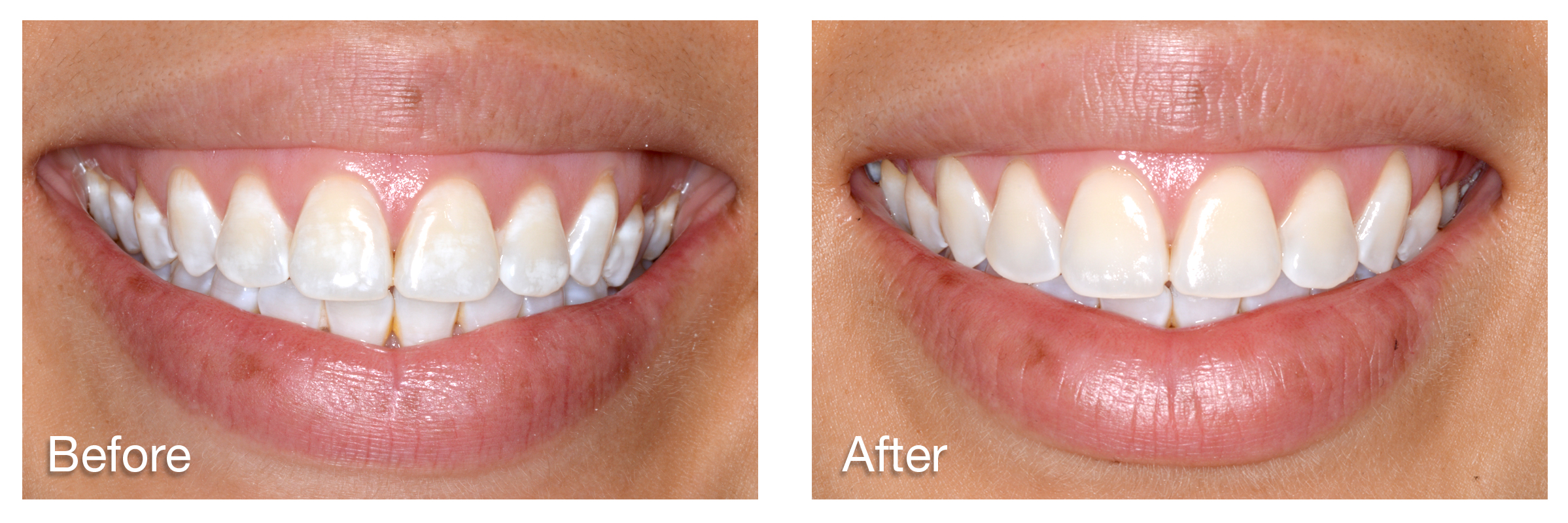 White Spots On Your Teeth