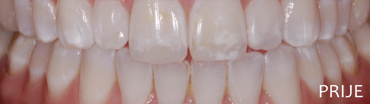 White Spots Removal Guide
