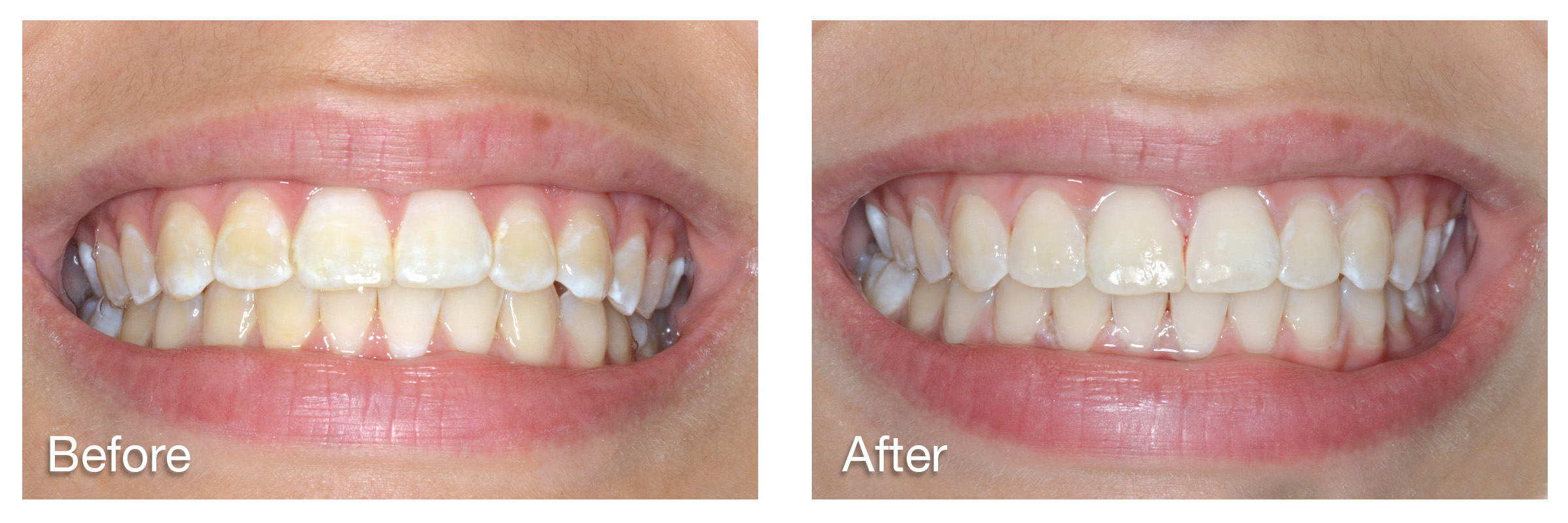 White Spots Teeth