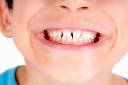 Why Are My Child S Adult Teeth Coming In Yellow What You Can Do Why Are My Child S Adult Teeth Coming In Yellow What You Can Do