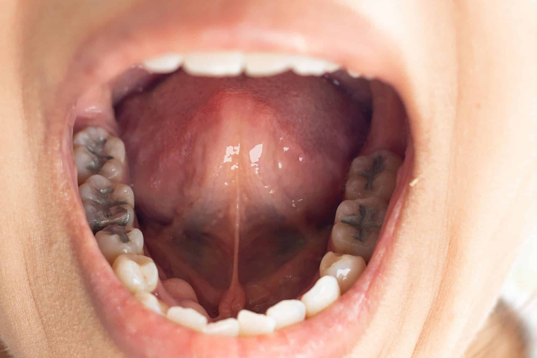 Why Do Fillings Hurt My Jaw? Find Quick Solutions