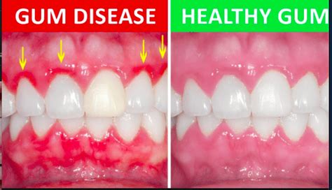 Why Do I Have Sore Gums From Cold? Quick Relief