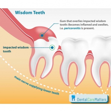 Why Do My Wisdom Teeth Smell So Bad Causes Treatment