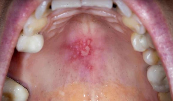 Why Does My Mouth Roof Hurt? Easy Fixes