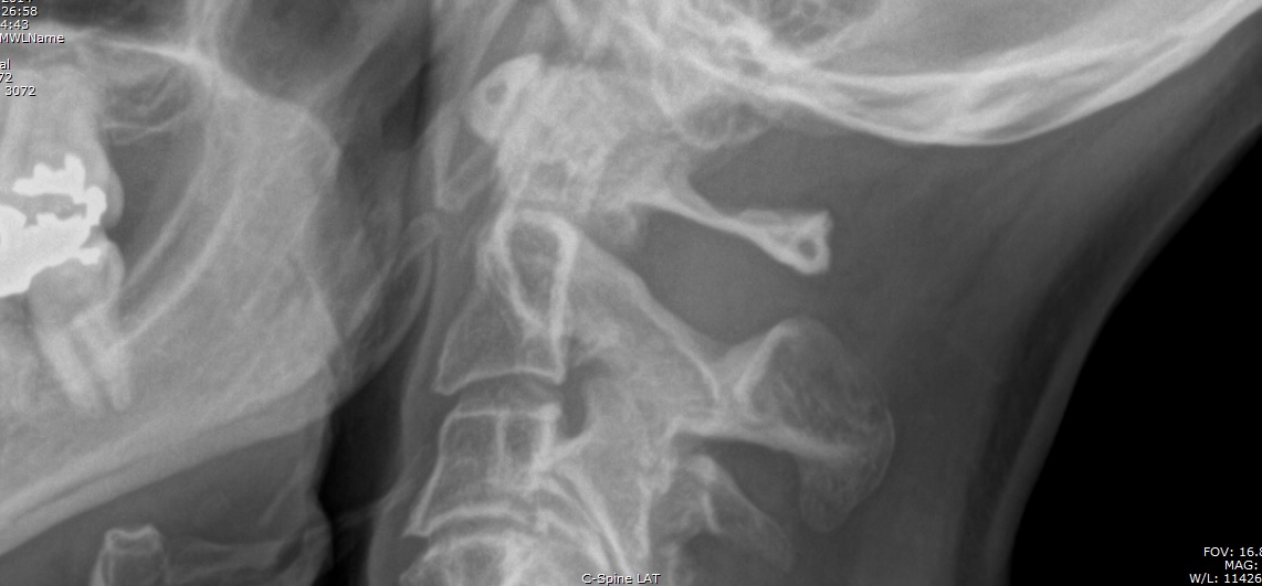 Why Does My Neck Pop? Easy Relief Solutions