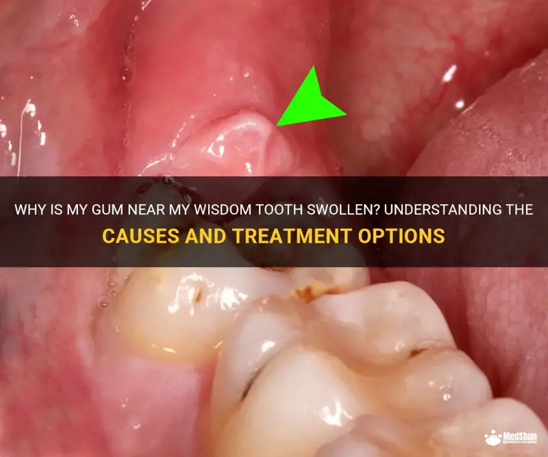 Why Is My Gum Swollen? Fix It Today