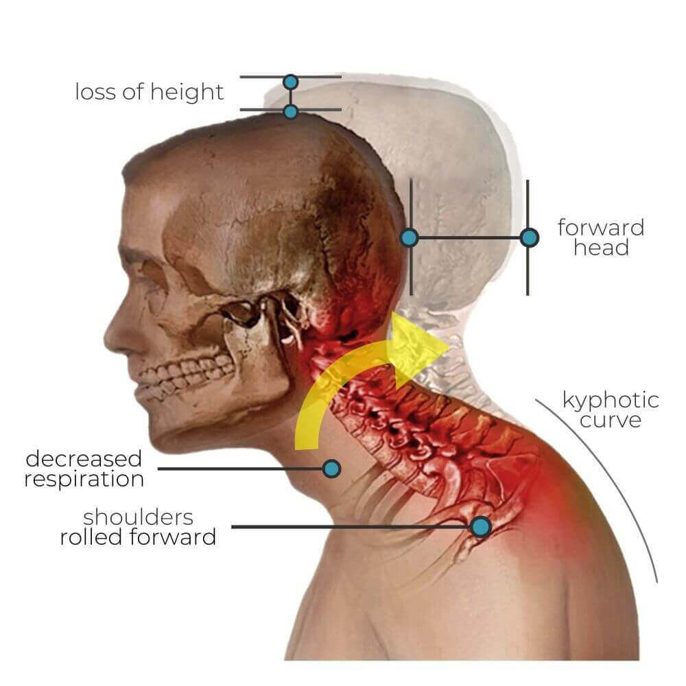 Why Neck Pain Worsens In Cold? Quick Relief Tips