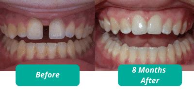 Will Retainers Shift Teeth Back