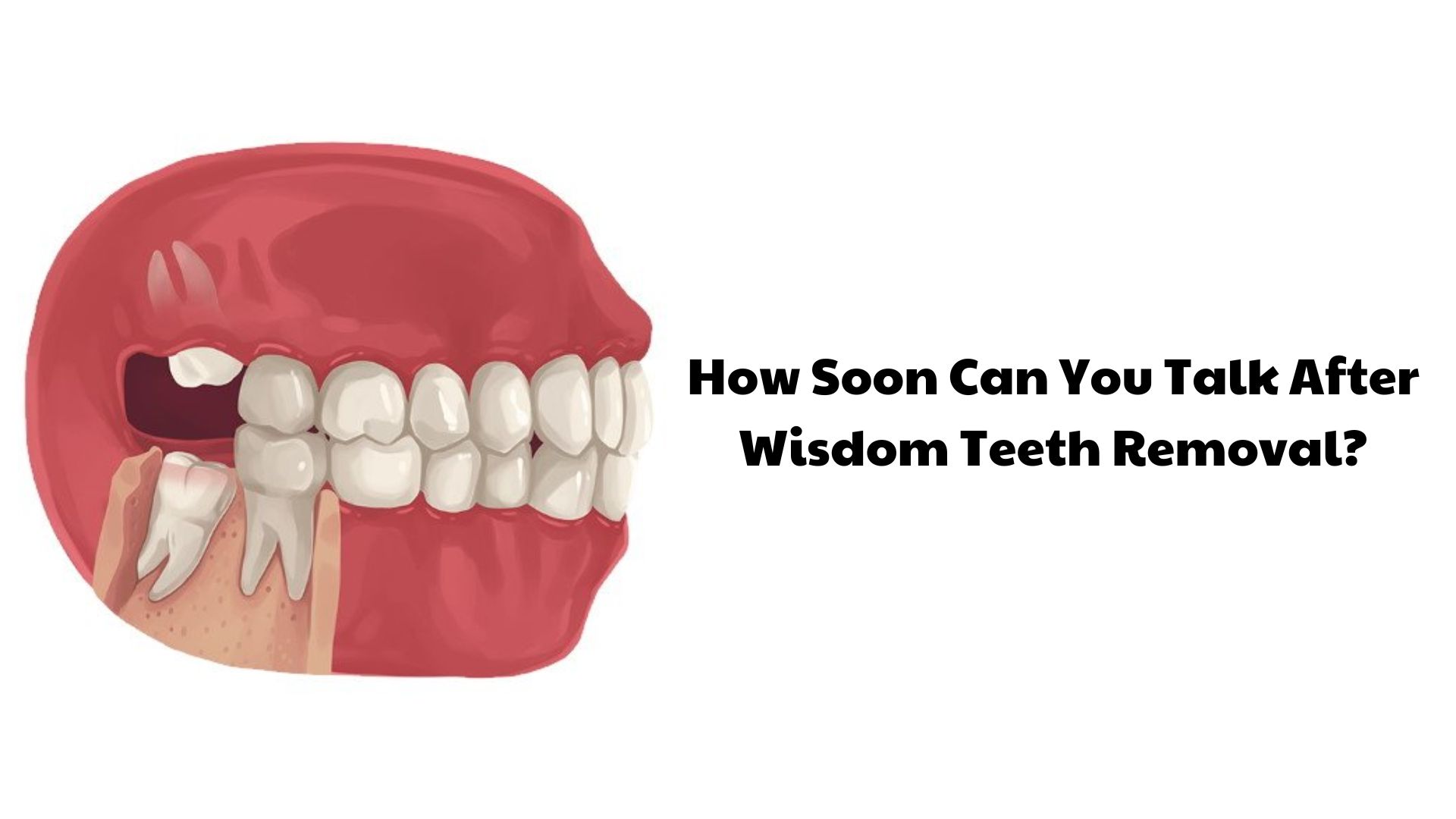 Wisdom Teeth Removal Charges