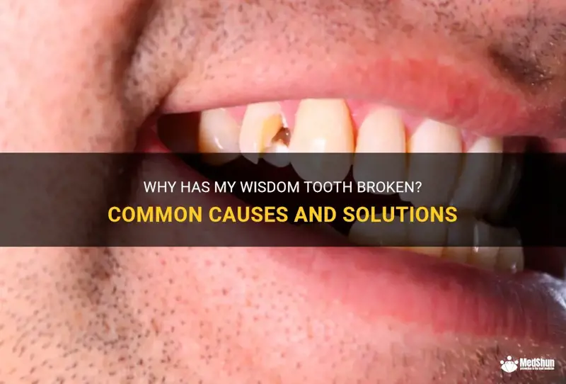 Wisdom Tooth Broke
