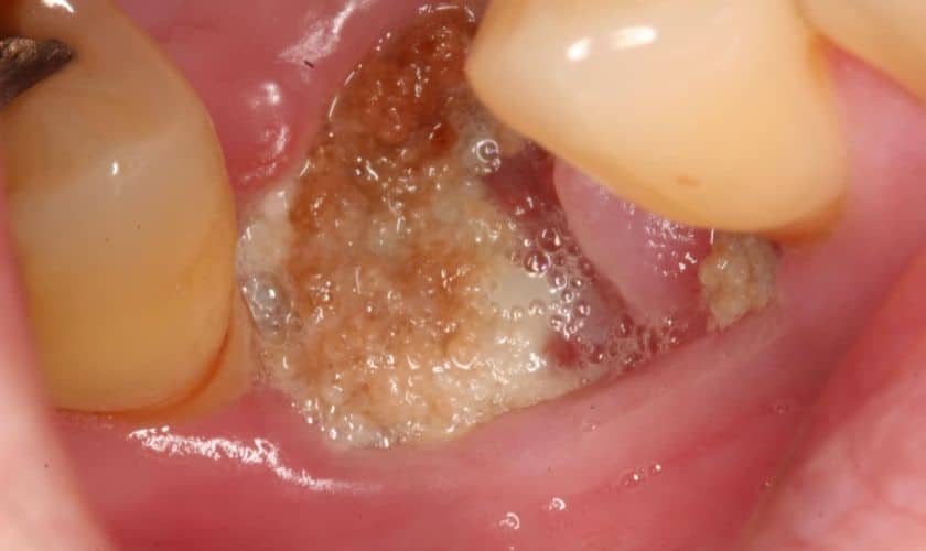 Wisdom Tooth Extraction: Safe Medication Options