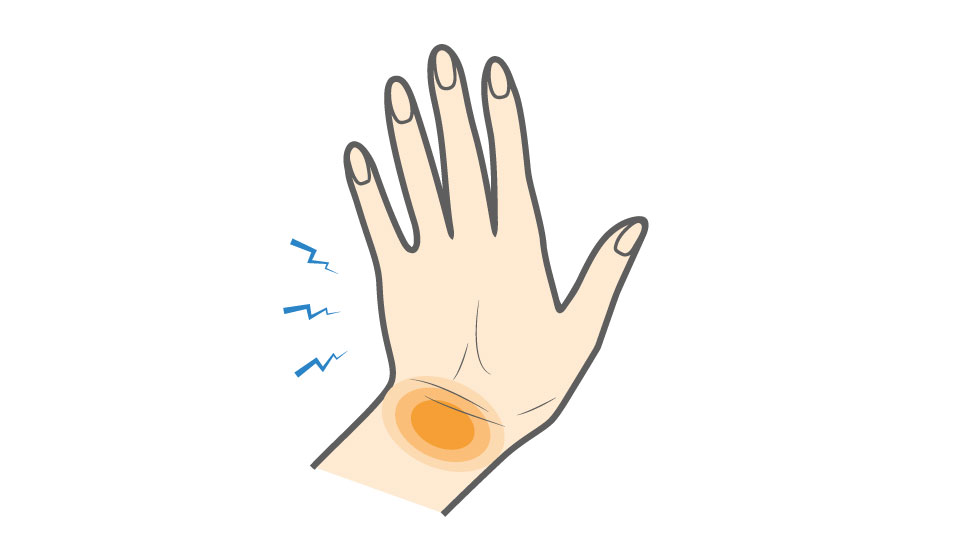 Wrist Sprain: Fast Relief With Simple Stretches