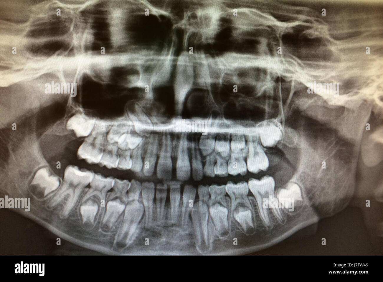 X Ray Of Childs Teeth