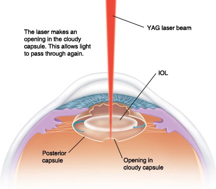 Yag Procedure On Eye